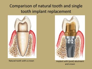 Dental Implants