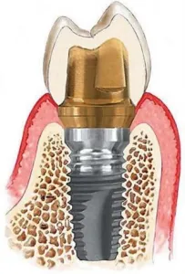 dental implants act as the foundation for replacement teeth