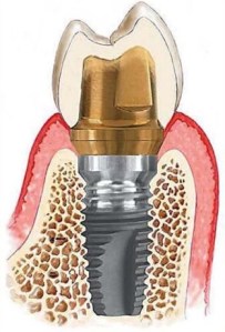 a replacement crown can be supported by a single dental implant