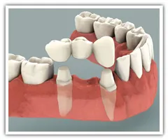 dental bridges rely on neighboring teeth for support