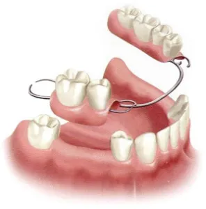 partials can help fill the gaps in your smile