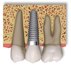 complete restorations incorporate dental implants, abutments, and crowns
